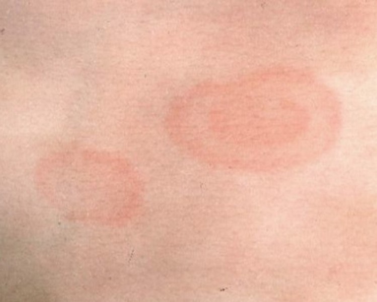 Лечение воспалений при кожных заболеваниях